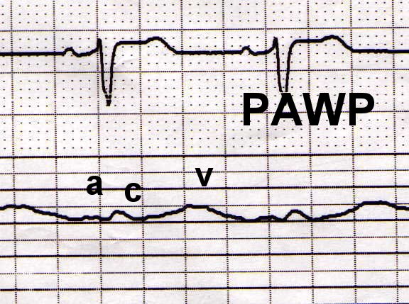 Pa Catheter Tracing