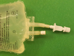 ileostomy loop lavage diverting colonic spike feeding bag enteral contents empty through tube lhsc open lactated ringers